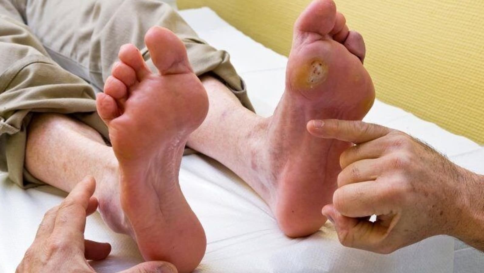 मधुमेह में पैर के अल्सर: पैर के अल्सर को रोकने के लिए 5 व्यावहारिक युक्तियों के साथ मधुमेह रोगियों के लिए सरल मार्गदर्शिका