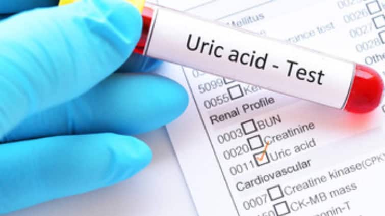 uric acid is a chemical created when the body breaks down substances called purines कहीं बढ़ तो नहीं रहा है आपका यूरिक एसिड? बिल्कुल नजरअंदाज ना करें ये लक्षण