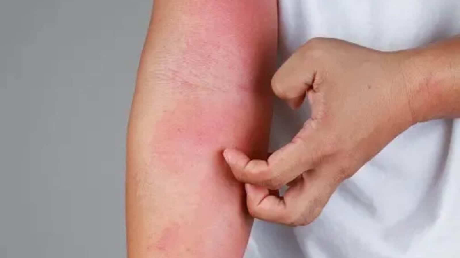 सामान्य त्वचा एलर्जी और त्वचा कैंसर के जोखिम से उनका संभावित संबंध